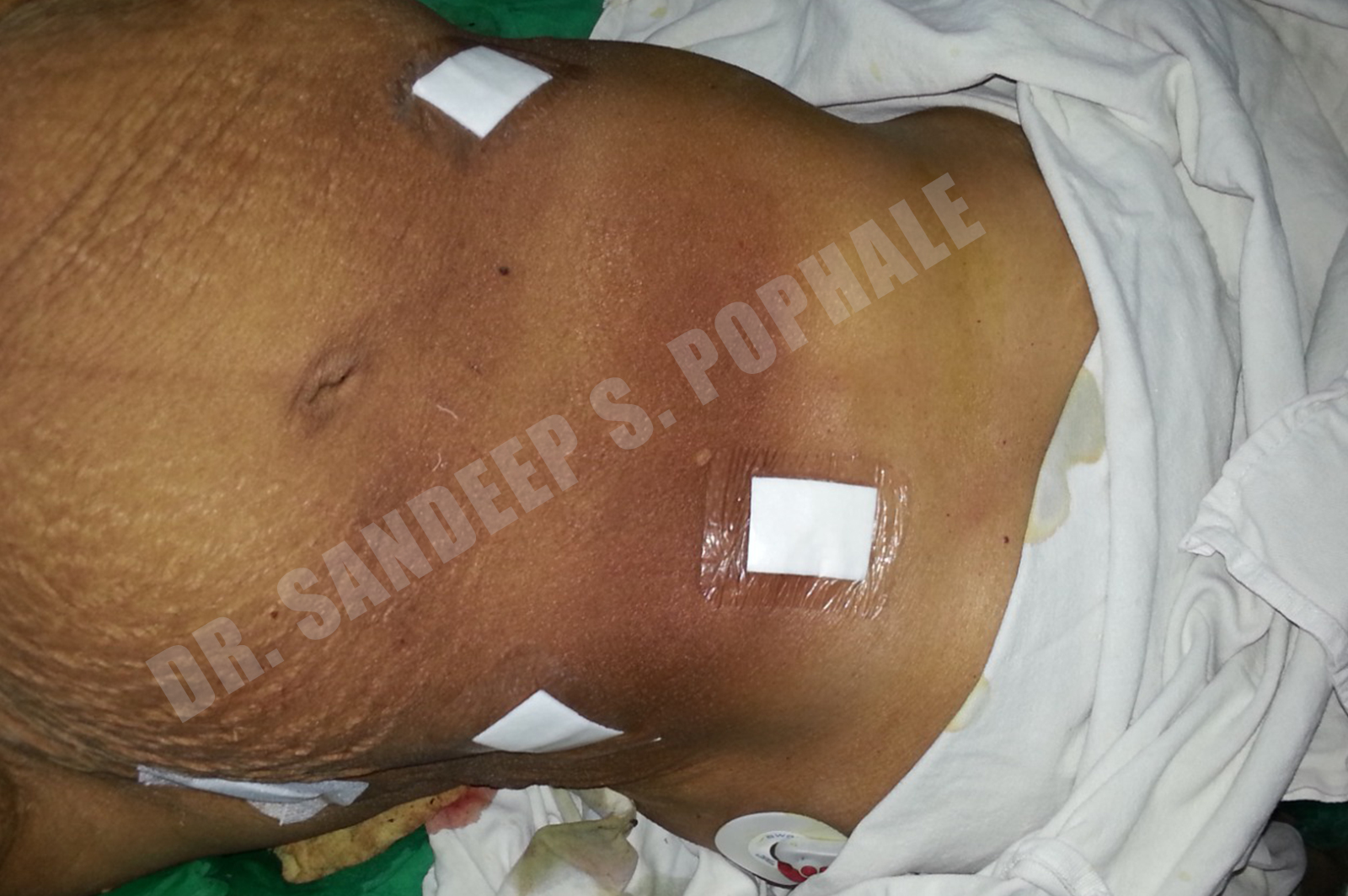 A-case-of-a-large-benign-ovarian-cyst-operated-laparoscopically