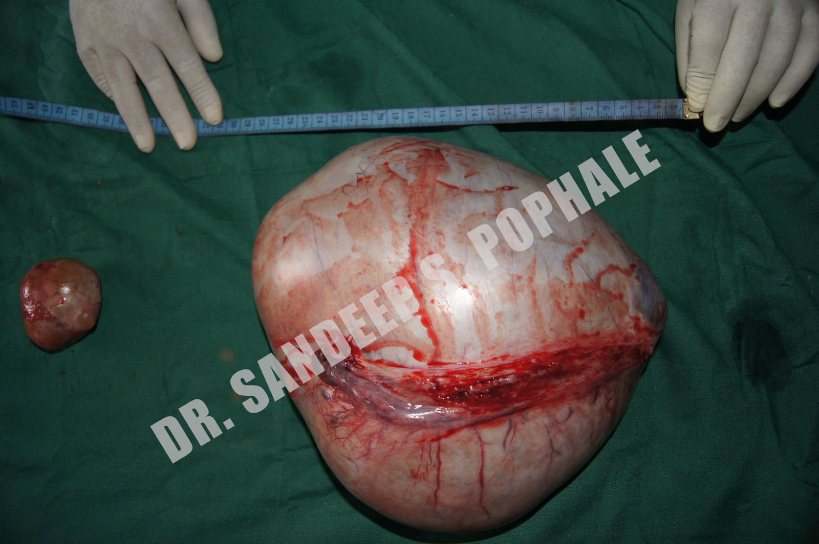Dr.-Sandhya-Pophale-operated-on-large-benign-ovarian-cyst