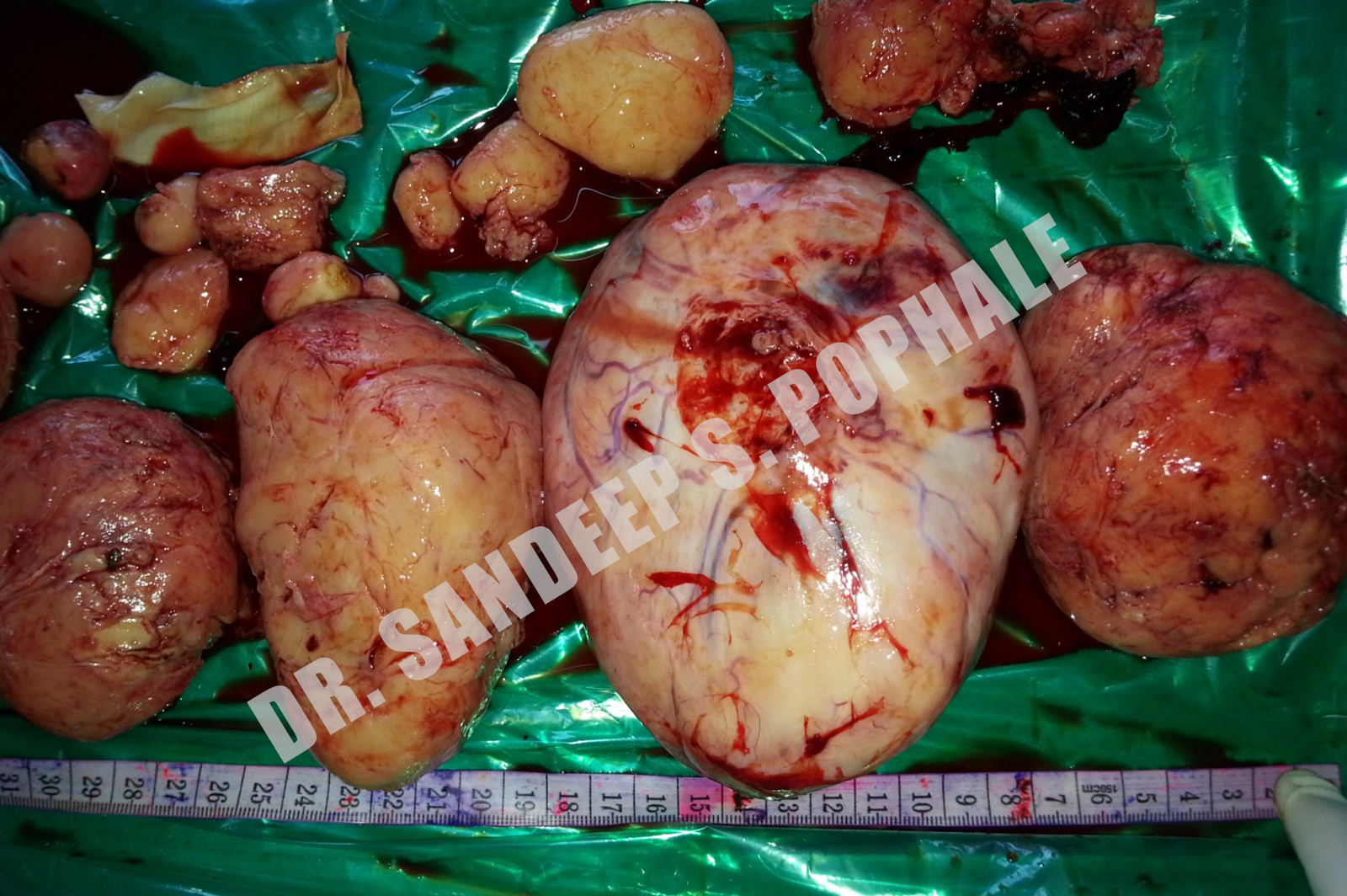 Surgery-of-large-multiple-fibroids2